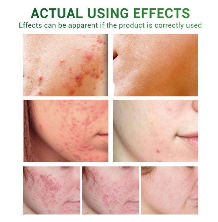 Acne Treatment Serum Facial Repair Oil - Magellan Fashion Shop